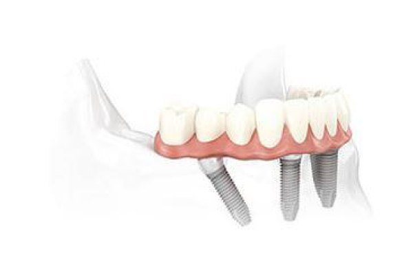 Pearl Dental - How Does It Works!