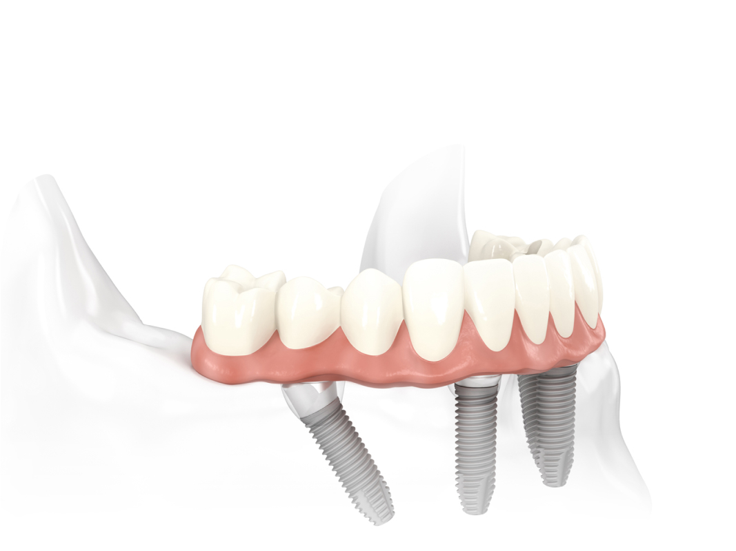 Dental Implant Procedure - Before