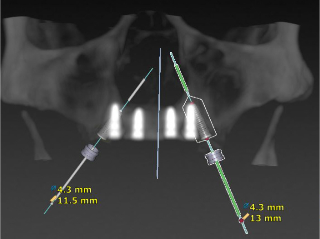 Dental Implant Procedure - Before