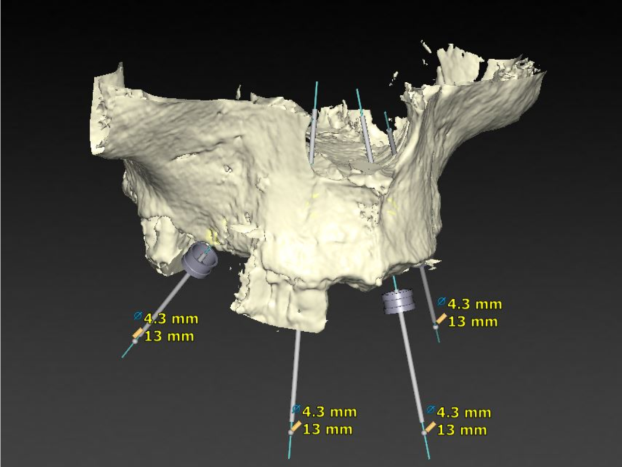 Dental Implant Procedure - Before
