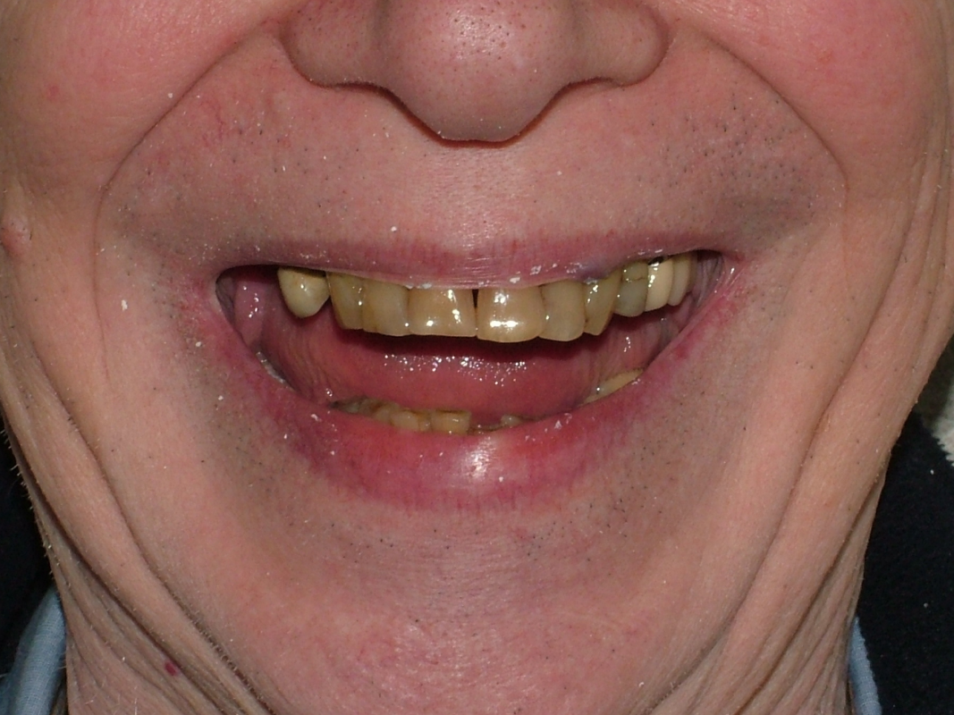 G1 Before