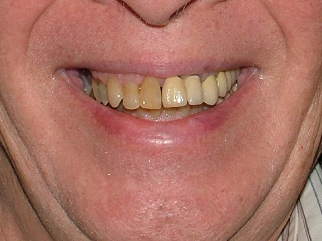 L1Before