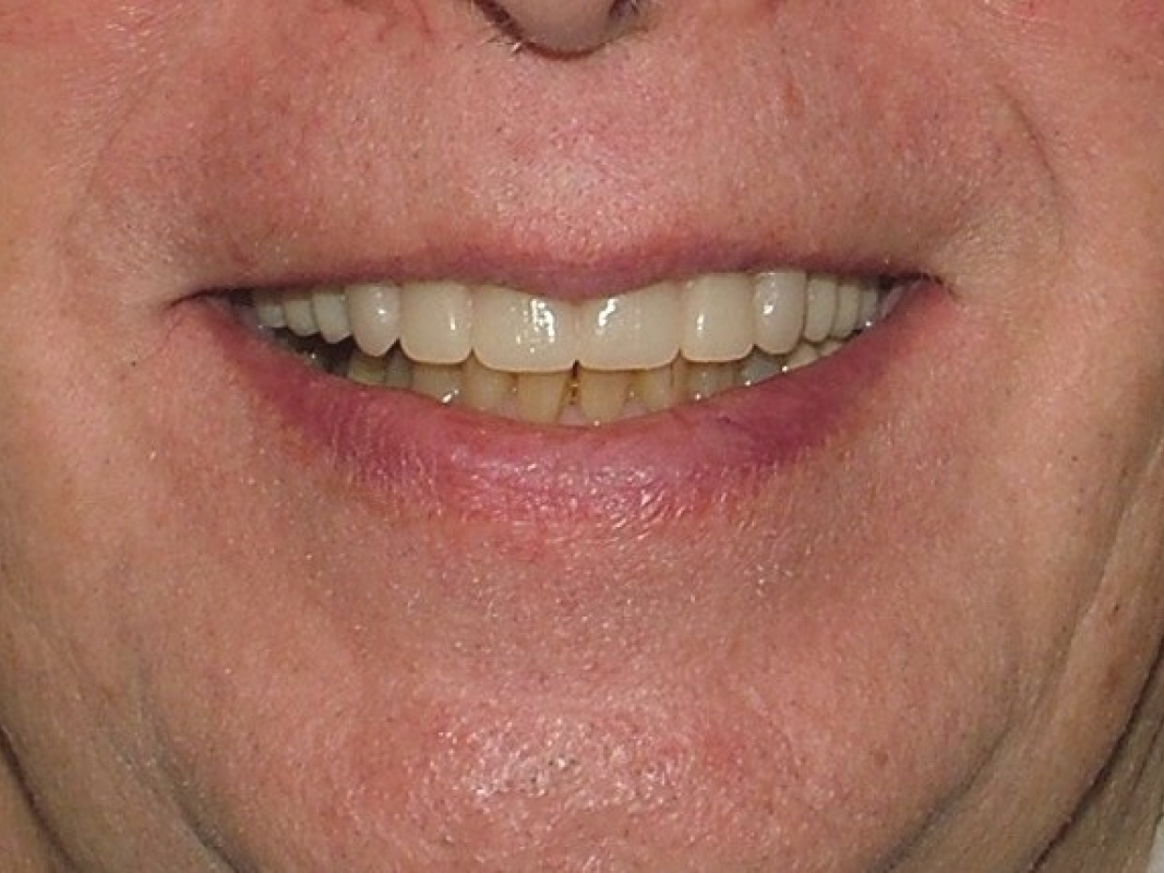 L2 After